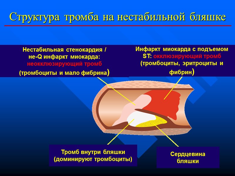 Структура тромба на нестабильной бляшке Нестабильная стенокардия / не-Q инфаркт миокарда: неокклюзирующий Структура тромба на нестабильной бляшке Нестабильная стенокардия / не-Q инфаркт миокарда: неокклюзирующий